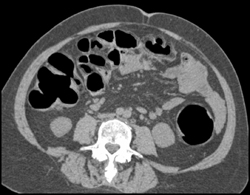 Virtual Colonoscopy With Stool in Cecum - CTisus CT Scan