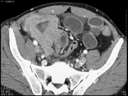 Cecal Lymphoma - CTisus CT Scan