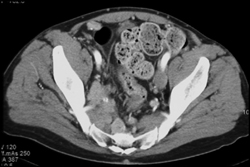 Tumor in Perirectal Zone Due to Melanoma - CTisus CT Scan