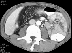 Ulcerative Colitis - CTisus CT Scan