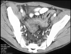 Ulcerative Colitis - CTisus CT Scan