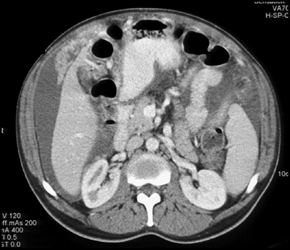 Carcinomatosis - CTisus CT Scan