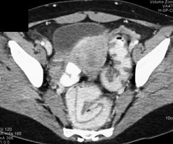 Worm in Colon-sporotrichosis - CTisus CT Scan