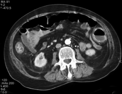 Ulcerative Colitis - CTisus CT Scan