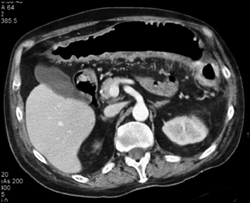 Ulcerative Colitis - CTisus CT Scan