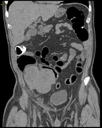 Cecal Cancer - CTisus CT Scan
