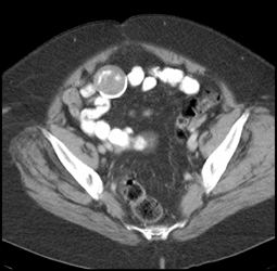 Meckel's Diverticulum - CTisus CT Scan