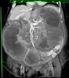 Fecal Impaction - CTisus CT Scan