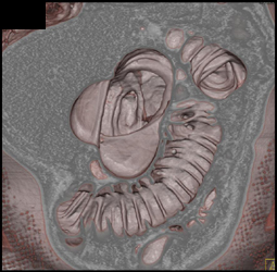 Virtual Colonoscopy With Diverticulosis - CTisus CT Scan
