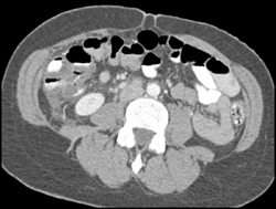 Cecal Cancer - CTisus CT Scan