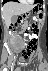 Cecal Cancer - CTisus CT Scan