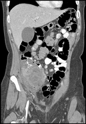 Cecal Cancer - CTisus CT Scan