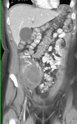 Cecal Cancer - CTisus CT Scan