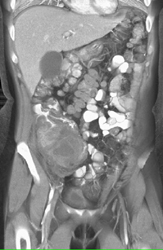 Cecal Cancer - CTisus CT Scan