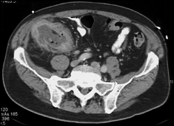 Cecal Cancer - CTisus CT Scan