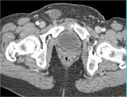 Poor Prep for Virtual Colon - CTisus CT Scan