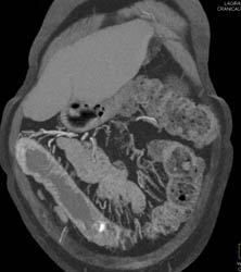Ischemic Colitis - CTisus CT Scan