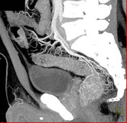 Ischemic Colitis - CTisus CT Scan