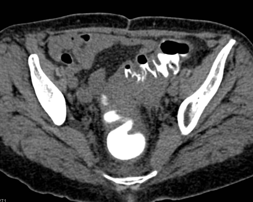 Acute Diverticulitis - CTisus CT Scan