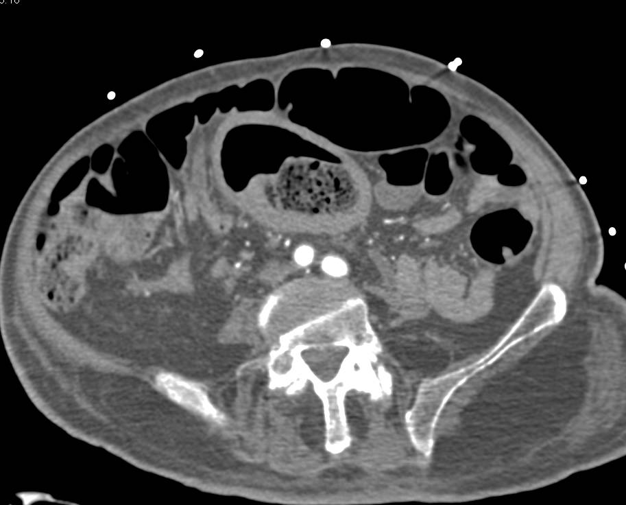 Sigmoid Volvulus - CTisus CT Scan