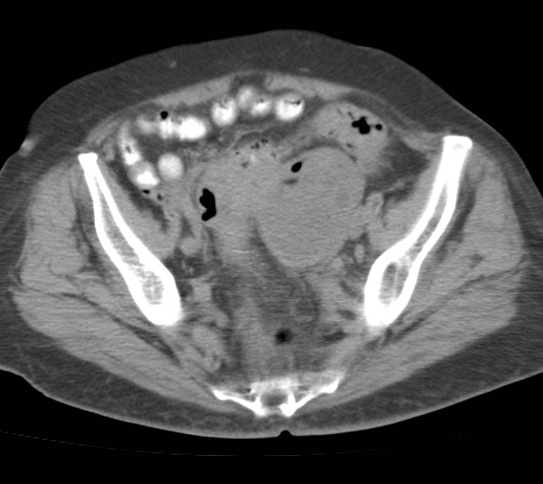 Diverticulitis with Pelvic Abscess - CTisus CT Scan