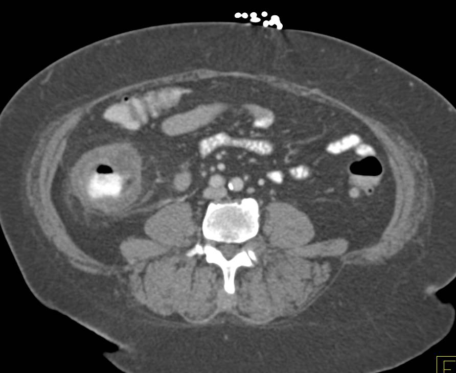 Ischemic Colitis of the Cecum and Right Colon Which Simulates Cecal Carcinoma - CTisus CT Scan