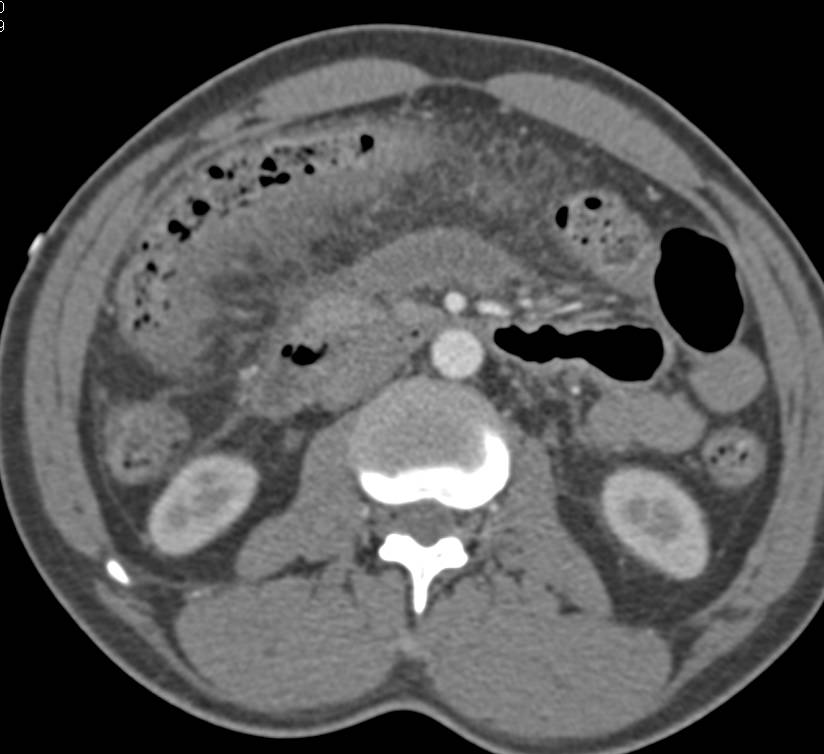 Infectious Colitis - CTisus CT Scan