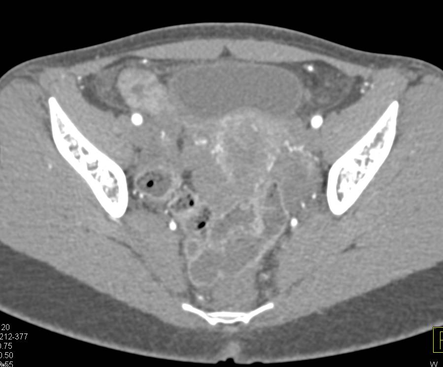 Crohn's Disease with Inflamed Cecum and Terminal Ileum - CTisus CT Scan