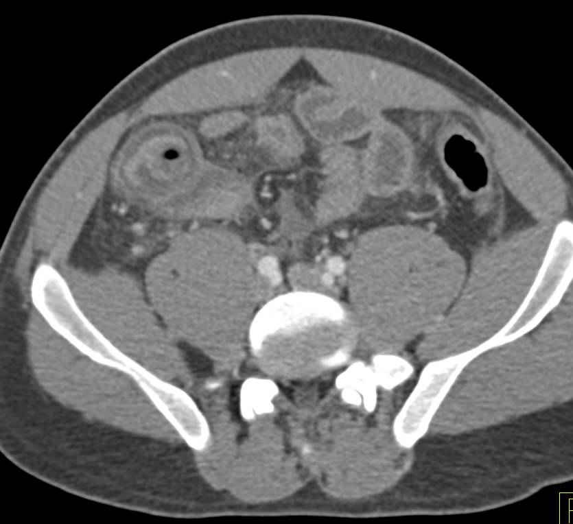 Appendicitis with Dilated Inflamed Appendix - CTisus CT Scan