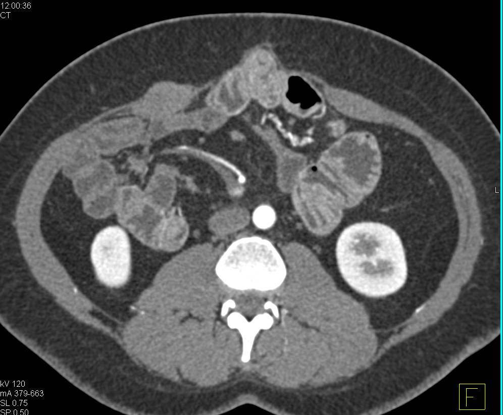 Colitis Recum and Midline Hernia - CTisus CT Scan