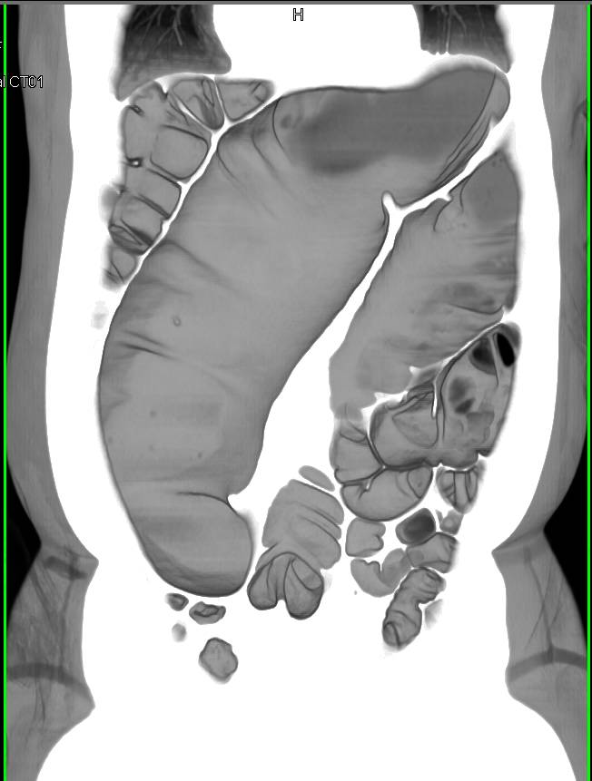 Sigmoid Volvulus - CTisus CT Scan