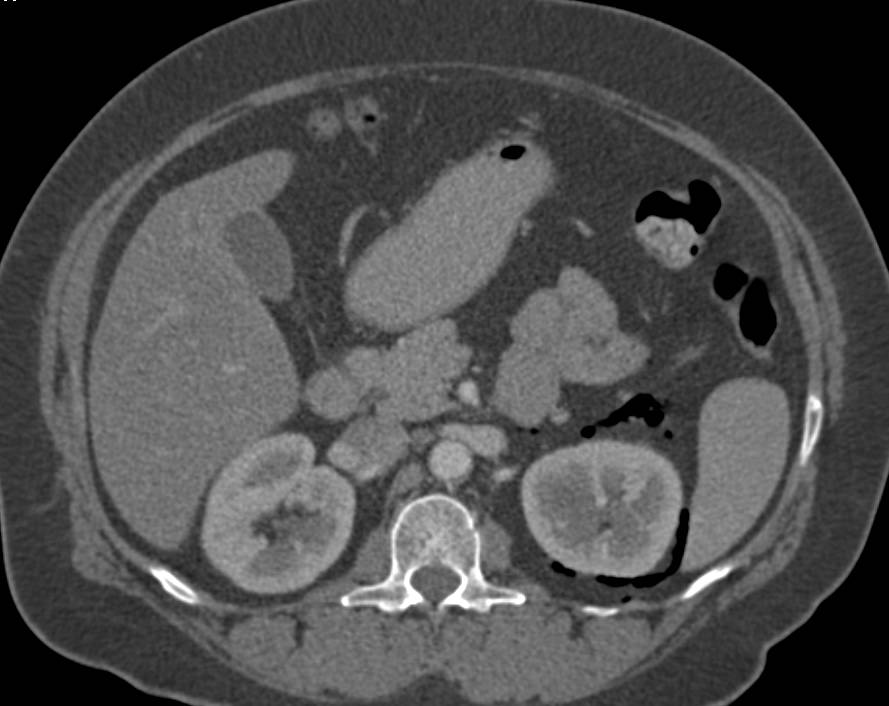 Perforated Left Colon with Air Tracking Near Left Kidney - CTisus CT Scan