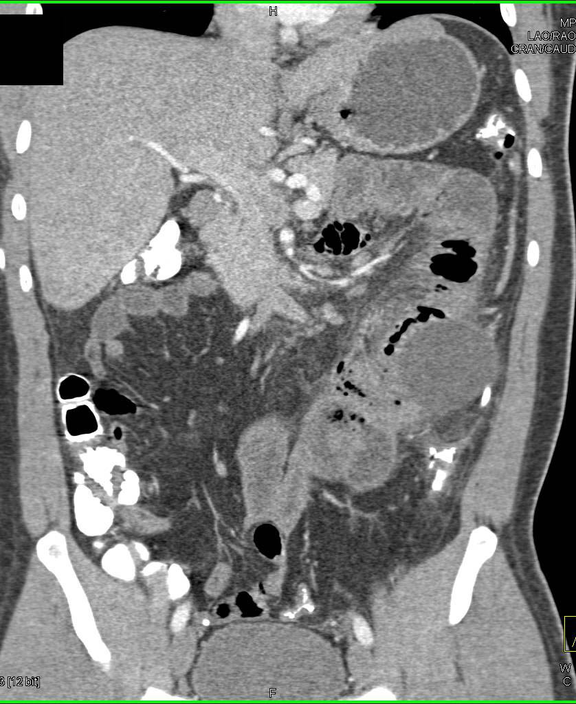 Colitis Descending Colon with Focal Perforation - CTisus CT Scan