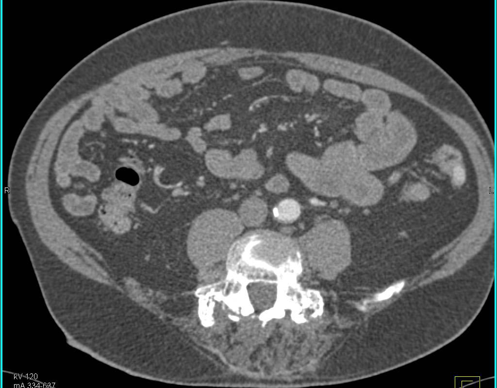 Gastrointestinal (GI) Bleed in Descending Colon due to Vascular Lesion - CTisus CT Scan