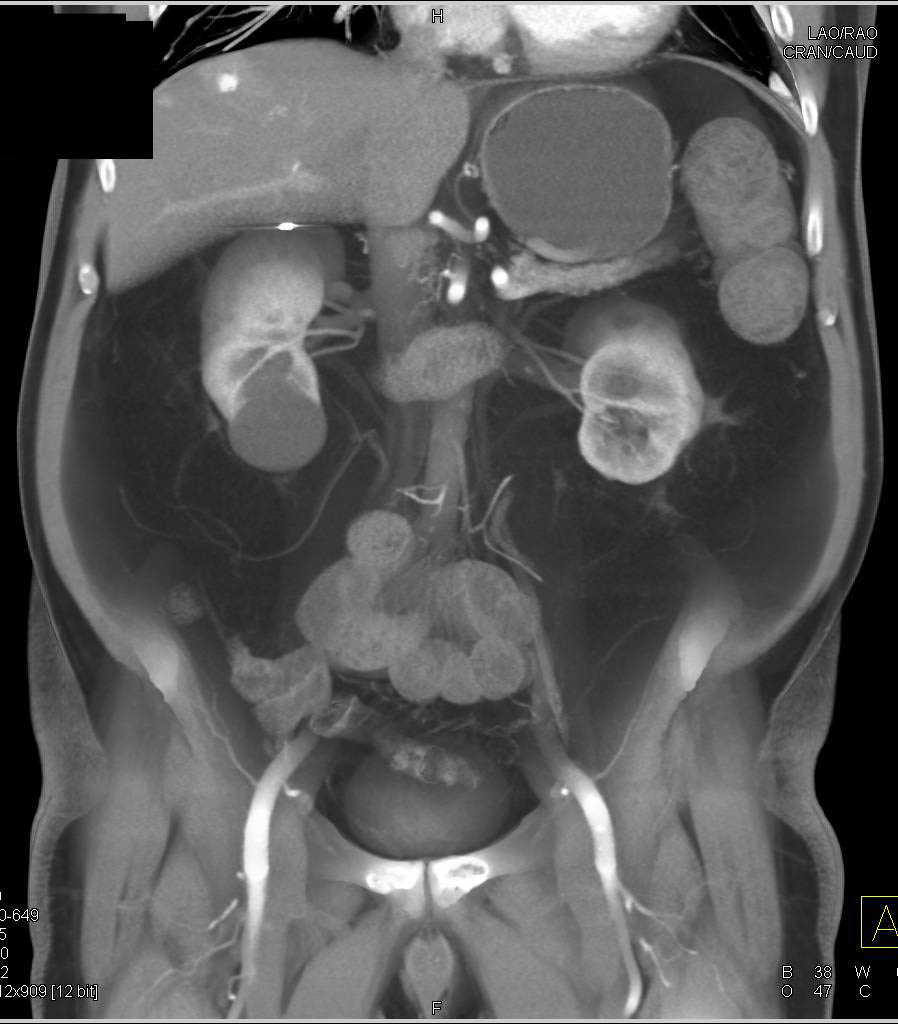 Ulcerative Colitis best seen in Ascending Colon with Incidental Hepatic Hemangioma - CTisus CT Scan