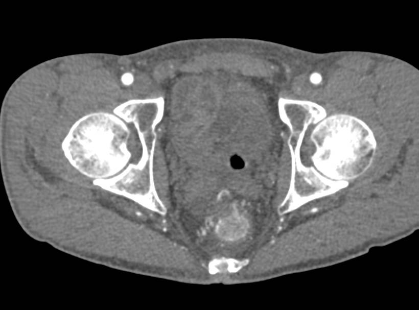 Rectal Bleed due to Hemorroids with Bright Rectal Enhancement - CTisus CT Scan