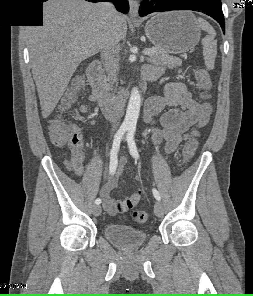 Ulcerative Colitis best seen in Transverse Colon - CTisus CT Scan