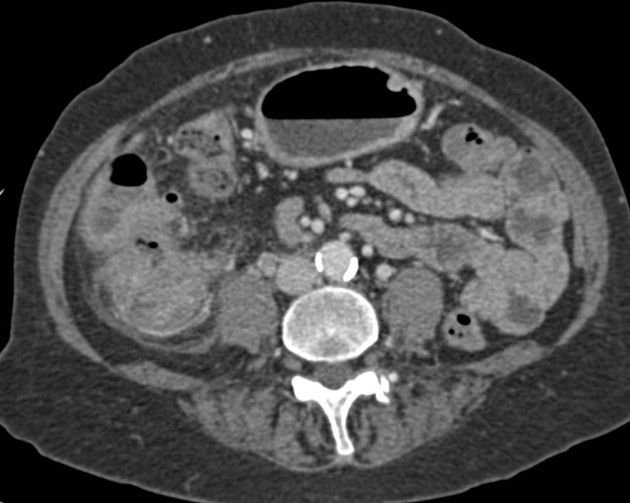 Cecal Carcinoma with Liver Metastases - CTisus CT Scan