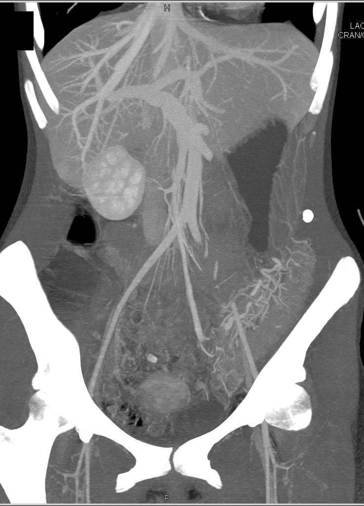 Ulcerative Colitis in Sigmoid Colon with Prominent Vasa Recta - CTisus CT Scan