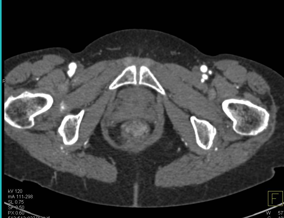 Ulcerative Colitis in Sigmoid Colon with Prominent Vasa Recta - CTisus CT Scan