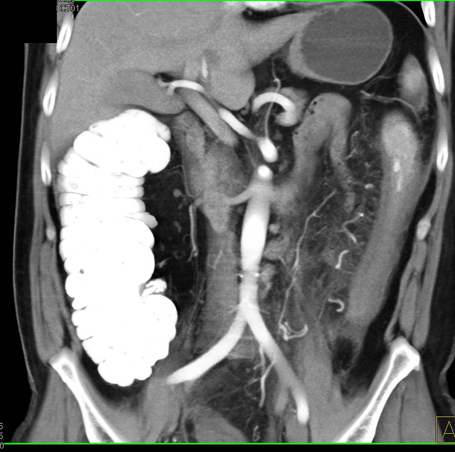 Ischemic Colitis Left Colon due to Venous Stasis - CTisus CT Scan