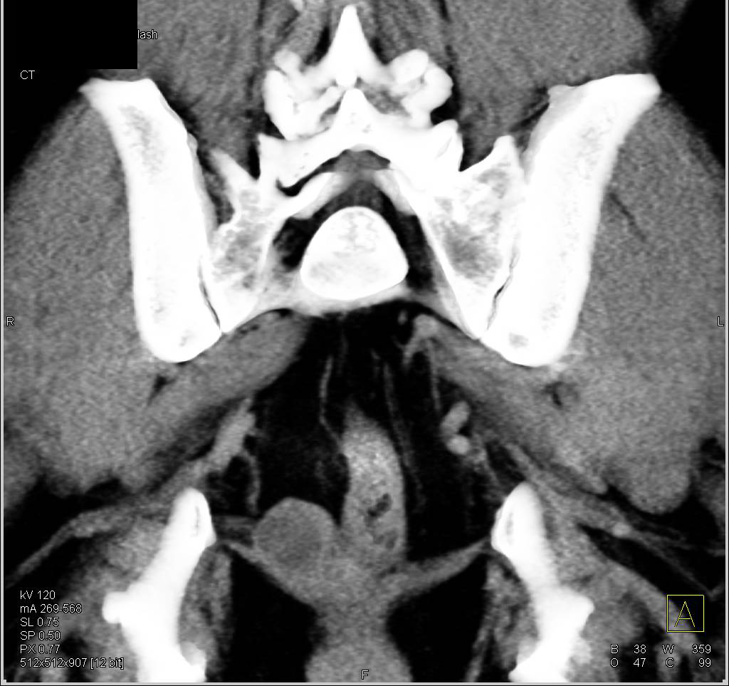 Perirectal Cyst - CTisus CT Scan