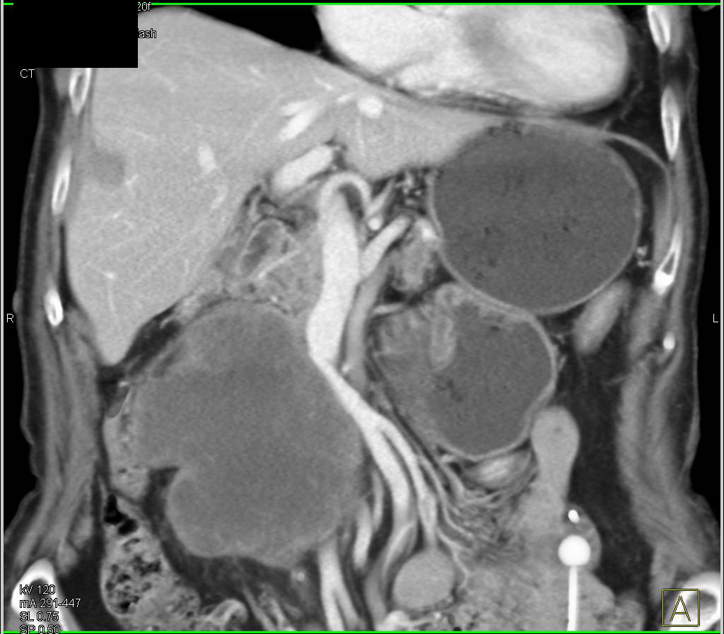 Recurrent Colon Cancer Near Head of Pancreas - CTisus CT Scan