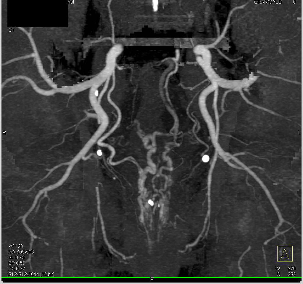 Gastrointestinal (GI) Bleed due to Rectal Varices - CTisus CT Scan