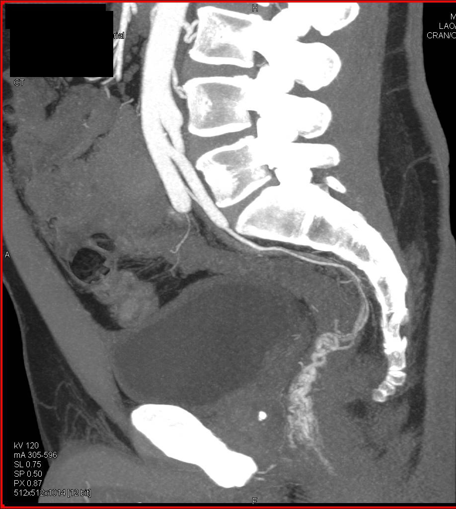 Gastrointestinal (GI) Bleed due to Rectal Varices - CTisus CT Scan