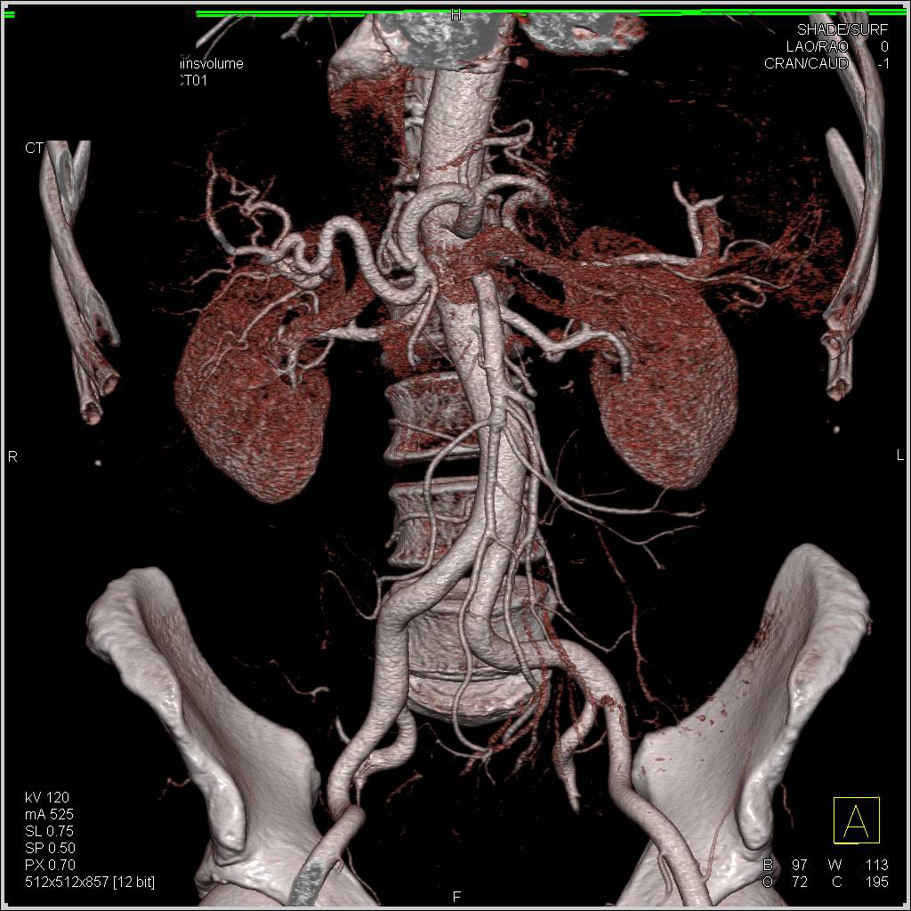 Colitis Sigmoid Colon with Normal Vascular Map - CTisus CT Scan