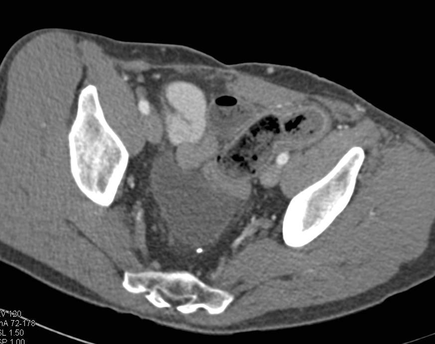 Ischemic Colitis Left Colon - CTisus CT Scan