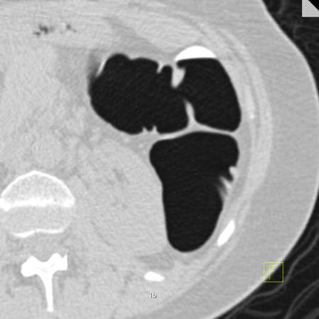 virtual colon: Small 7 mm polyp descending colon. - CTisus CT Scan