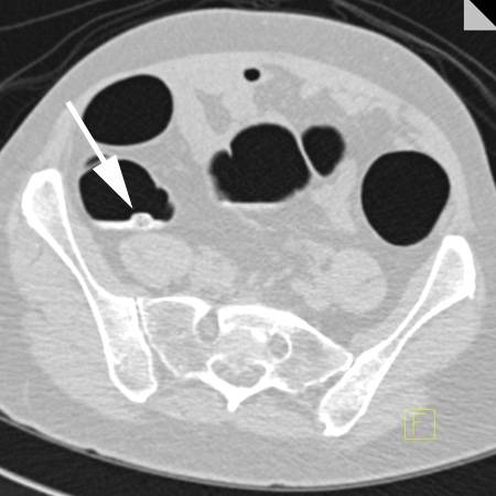 virtual colon: Stool in sigmoid. - CTisus CT Scan