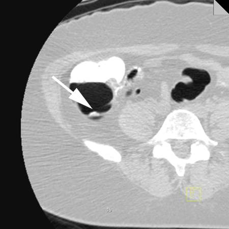 virtual colon: Small polyp (9mm) ascending colon, on fold. - CTisus CT Scan